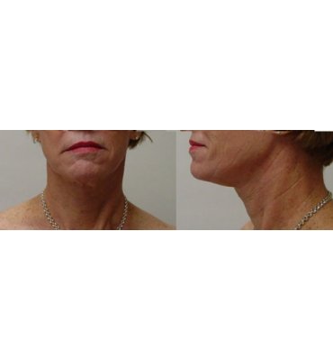 Face Rejuvenation Treatments Before