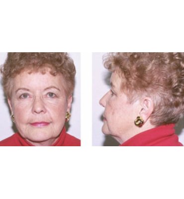 Easy Facial Rejuvenation Procedures Before