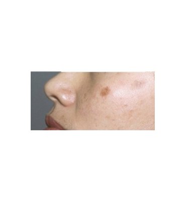 Shave Excision For Hyperpigmentation Before