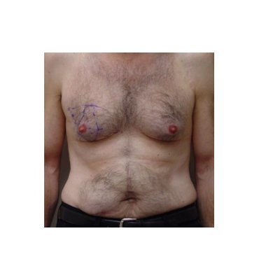 Skin Excision In Gynecomastia Before