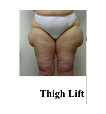 Thigh Lift Vs. Liposuction Before