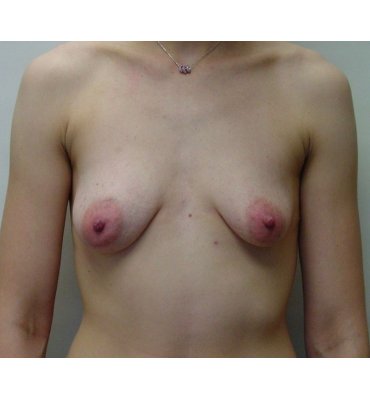 370px x 400px - Breast Augmentation Before & After Photo Gallery | Dr. Michael Kreidstein