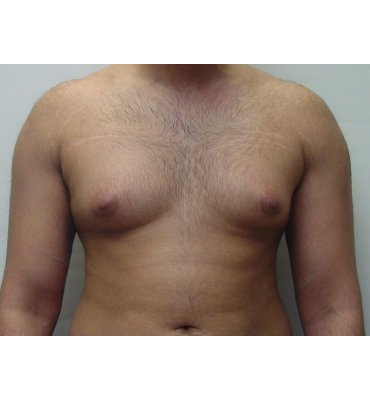 stretch marks gynecomastia