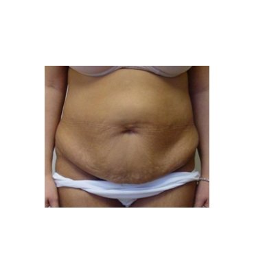 Stretch Marks & Abdominoplasty Before