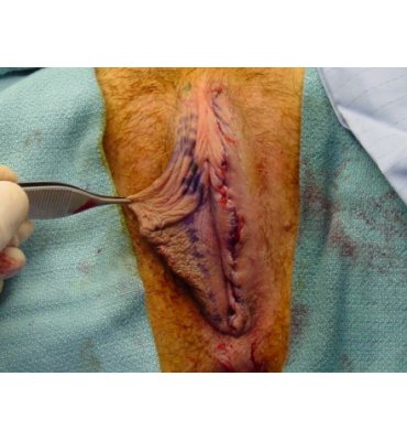 Trim Labiaplasty Before