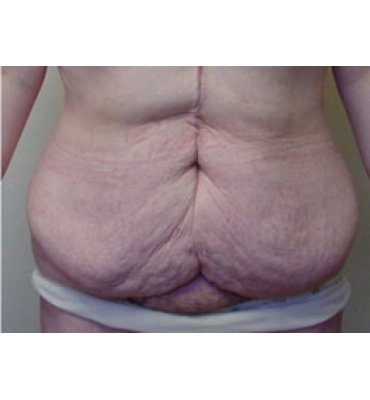 Fleur-De-Lis Abdominoplasty Before
