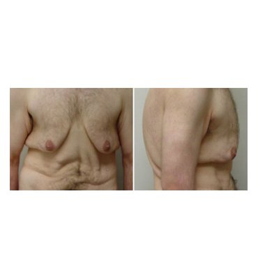 Cutis Pleonasmus & Male Breast Reduction Before