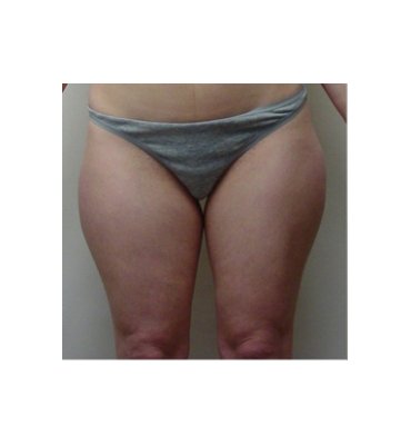 Liposuction Instead Of Weight-Loss Before