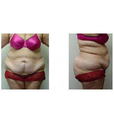 Body Contour Surgery-Customized Before