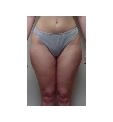 Liposuction Abdomen & Thighs Before