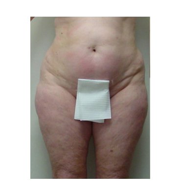 Liposuction And Cellulite Before