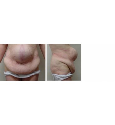 Ventral Hernia Repair And Abdominoplasty Before