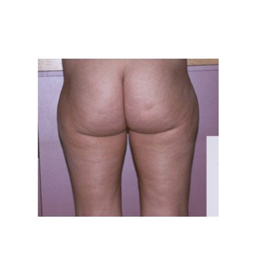 Liposuction Buttocks & Thighs Before