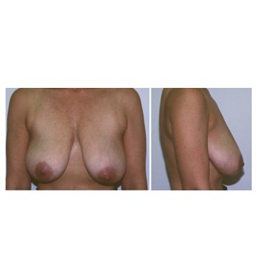 Breast Reduction Before