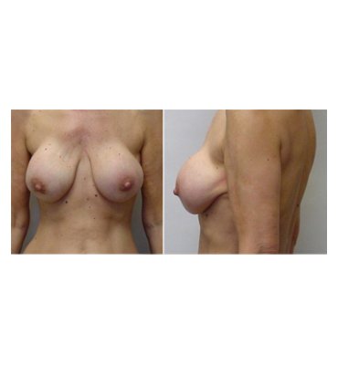 Breast Implant Removal & Mastopexy Before