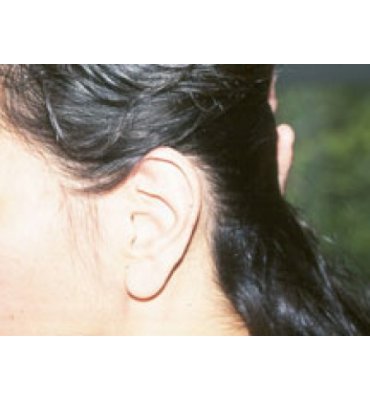 Ear Surgery Before
