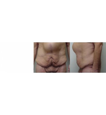 Hernia Repair And Abdominoplasty Before