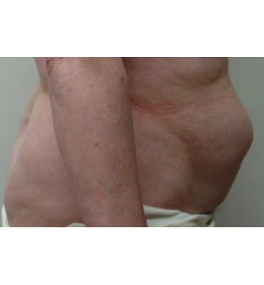 Abdominoplasty Including Fascial Repair Before