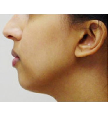 Chin Implant & Rhinoplasty Before