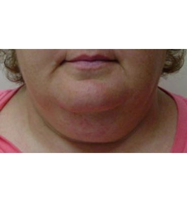 Liposuction For Jaw & Neckline Before