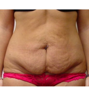 Before Abdominoplasty