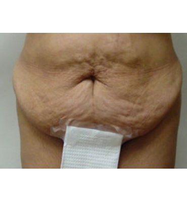 Tummy Tuck Procedure And Stretch Marks Before