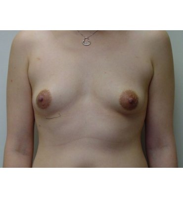 tubular-breast-pre