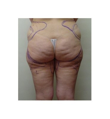 Cellulite And Liposuction Before