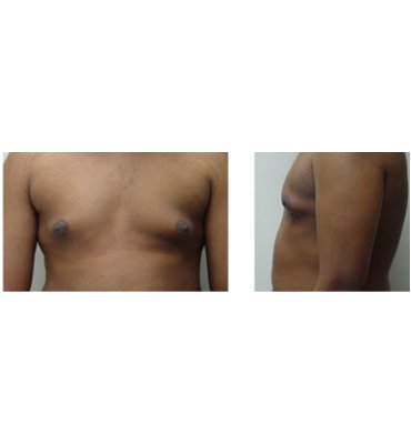 Natural Results From Gynecomastia Surgery Before