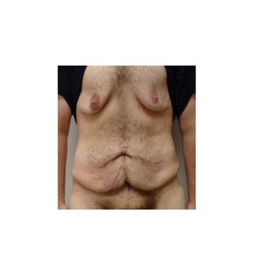 Male Breast Reduction Before Weight Loss