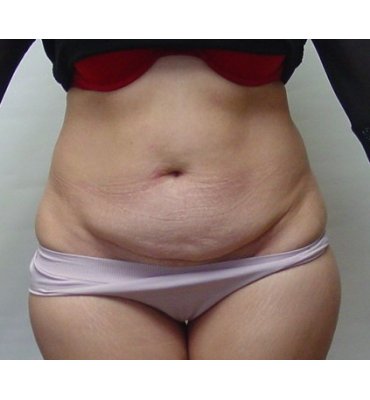 Abdominoplasty Before & After Photo Gallery