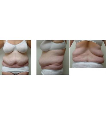 Combination Body Contour Surgery Before