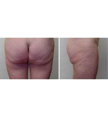 Infra Gluteal Buttock Lift Before