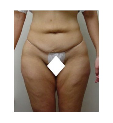 Combination Medial Thigh Lift & Abdominoplasty Before