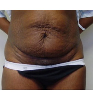 Tummy Tuck And Mons/Anterior Thigh Before