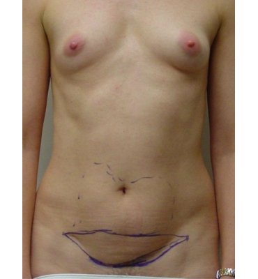 contouring of abdomen with liposuction and mini-abdominoplasty