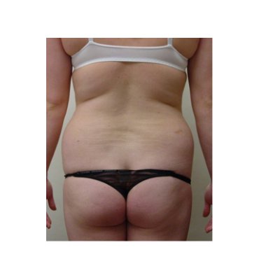 Liposuction Hips & Thighs Before