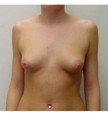 breast augmentaion after 11 years