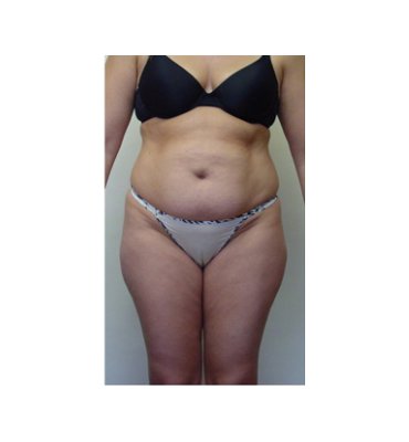 Skin Excess Before Liposuction