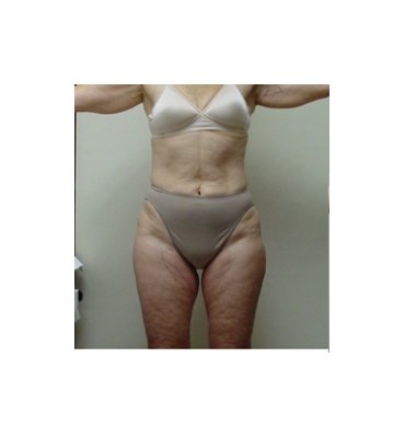 Liposuction Surgery Before
