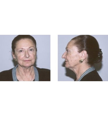 Simplified Facial Rejuvenation Procedures Before