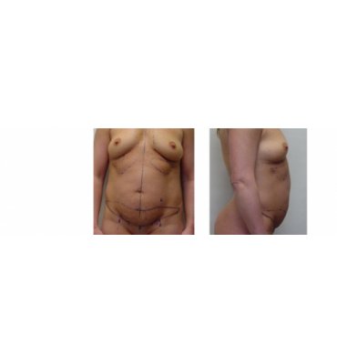 Liposuction & Cohesive Gel Breast Augmentation Before