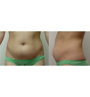 Abdominal Liposuction Before