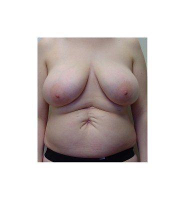 Scar Revision With Umbilicoplasty Before