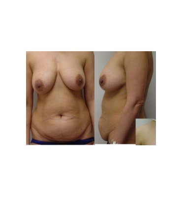 Combination Breast & Abdominal Surgery Before