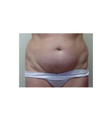 Tummy Tuck With Liposuction Before