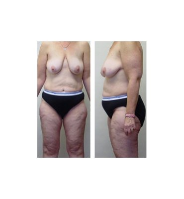 Combination Cosmetic Body Contour Surgery Before