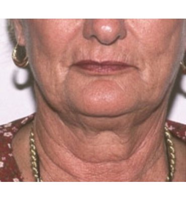 Facial Rejuvenation For Aged Women Before