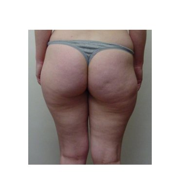 Buttock And Liposuction Before
