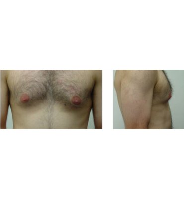 Before Combination Treatment For Male Breast Enlargement